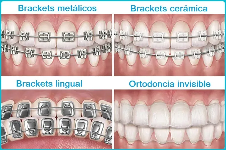 Ortodoncia invisible en Benet�sser